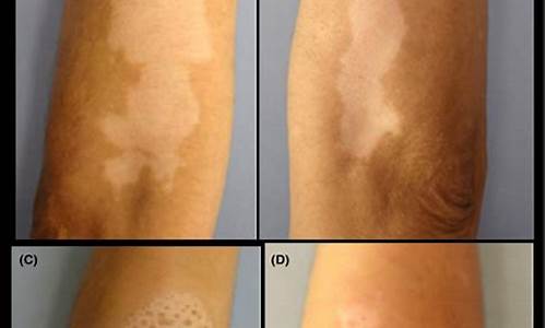 肉桂治疗白癜风进展指南最新版_肉桂治疗皮